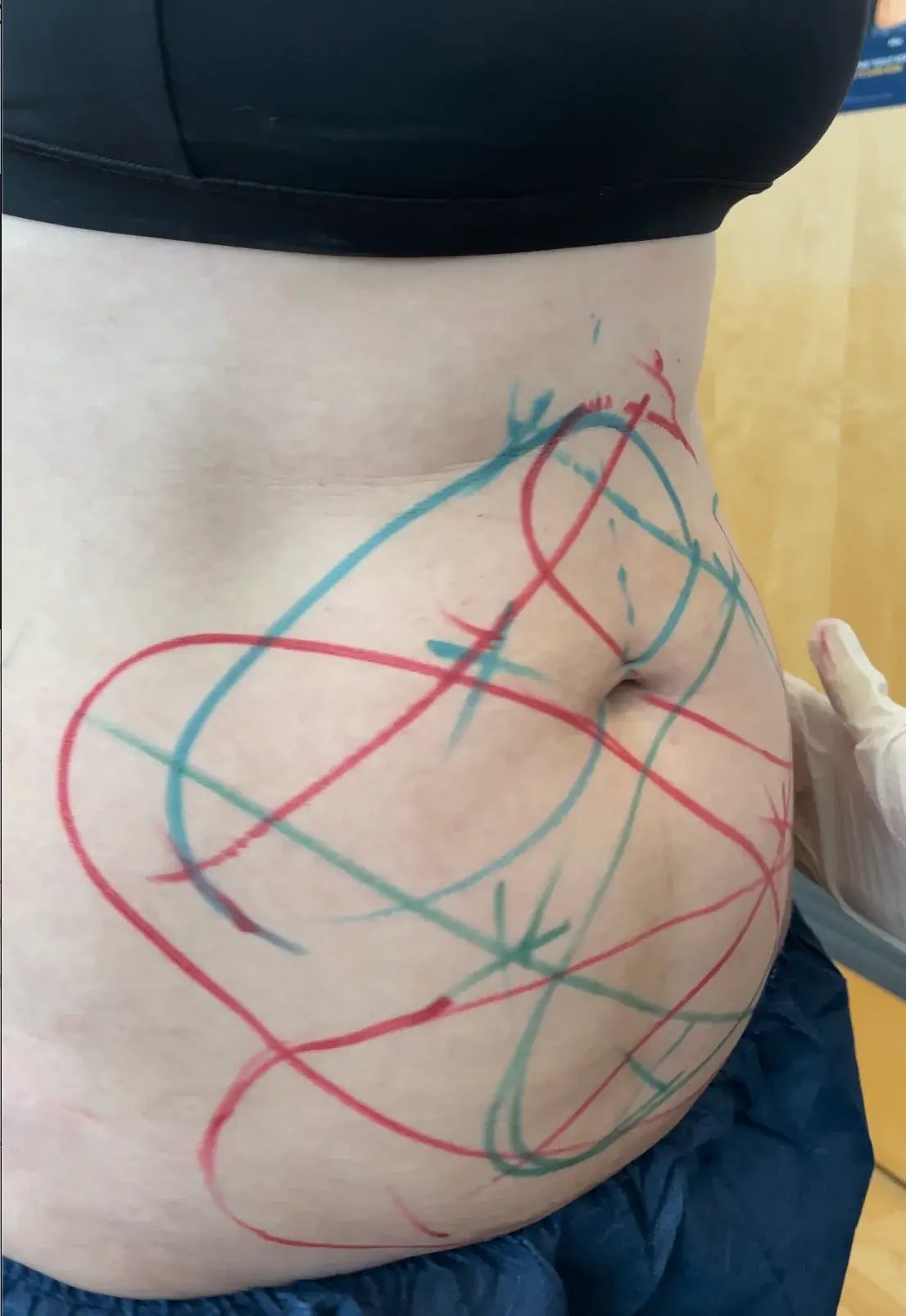 close-up-of-persons-abdomen-with-red-and-blue-markings-before-fat-reduction-treatment-wearing-black-top-and-dark-blue-shorts