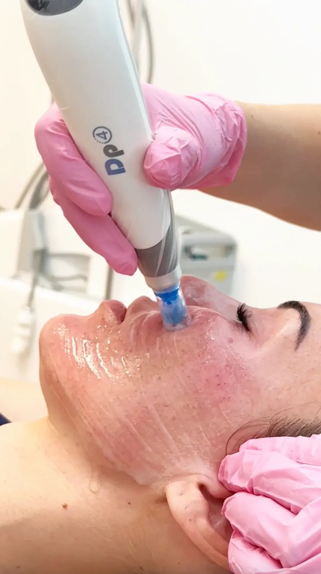 close-up-of-woman-receiving-microneedling-treatment-with-dp4-device-applied-to-face-by-professional-wearing-pink-gloves-with-microneedling-victoria-bc-1