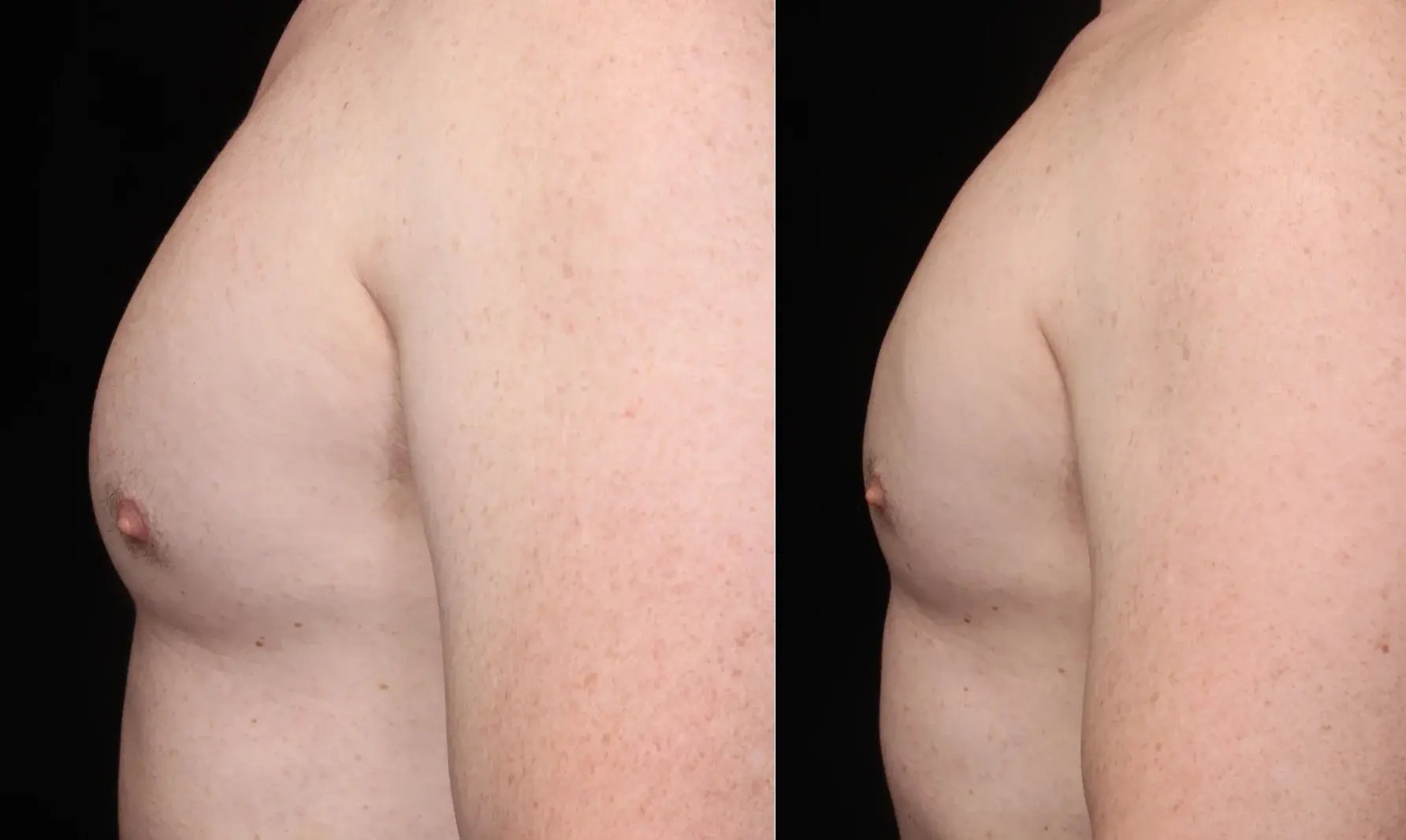 side-by-side-before-and-after-photo-of-male-chest-showing-fat-reduction-results-from-coolsculpting-victoria-bc-treatment-on-upper-body