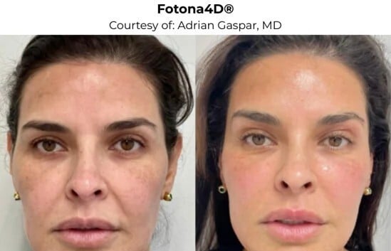 Fotona in Skin Tightening in Victoria