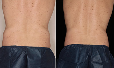 coolsculpting