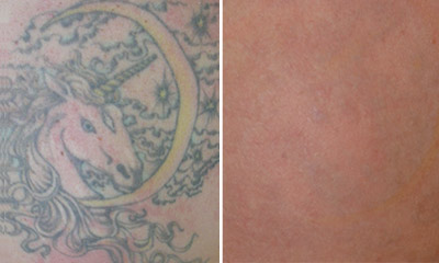 Laser Tattoo Removal | Safely Remove Tattoos for Good‎ | Victoria BC
