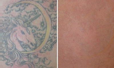 Before & After - Tattoos for laser removal - Cosmedica Victoria