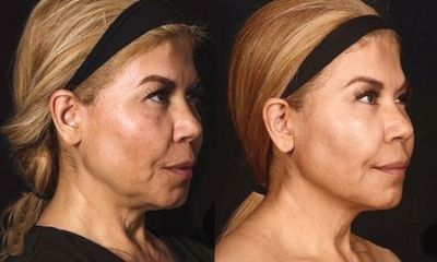 Morpheus8 Before + After